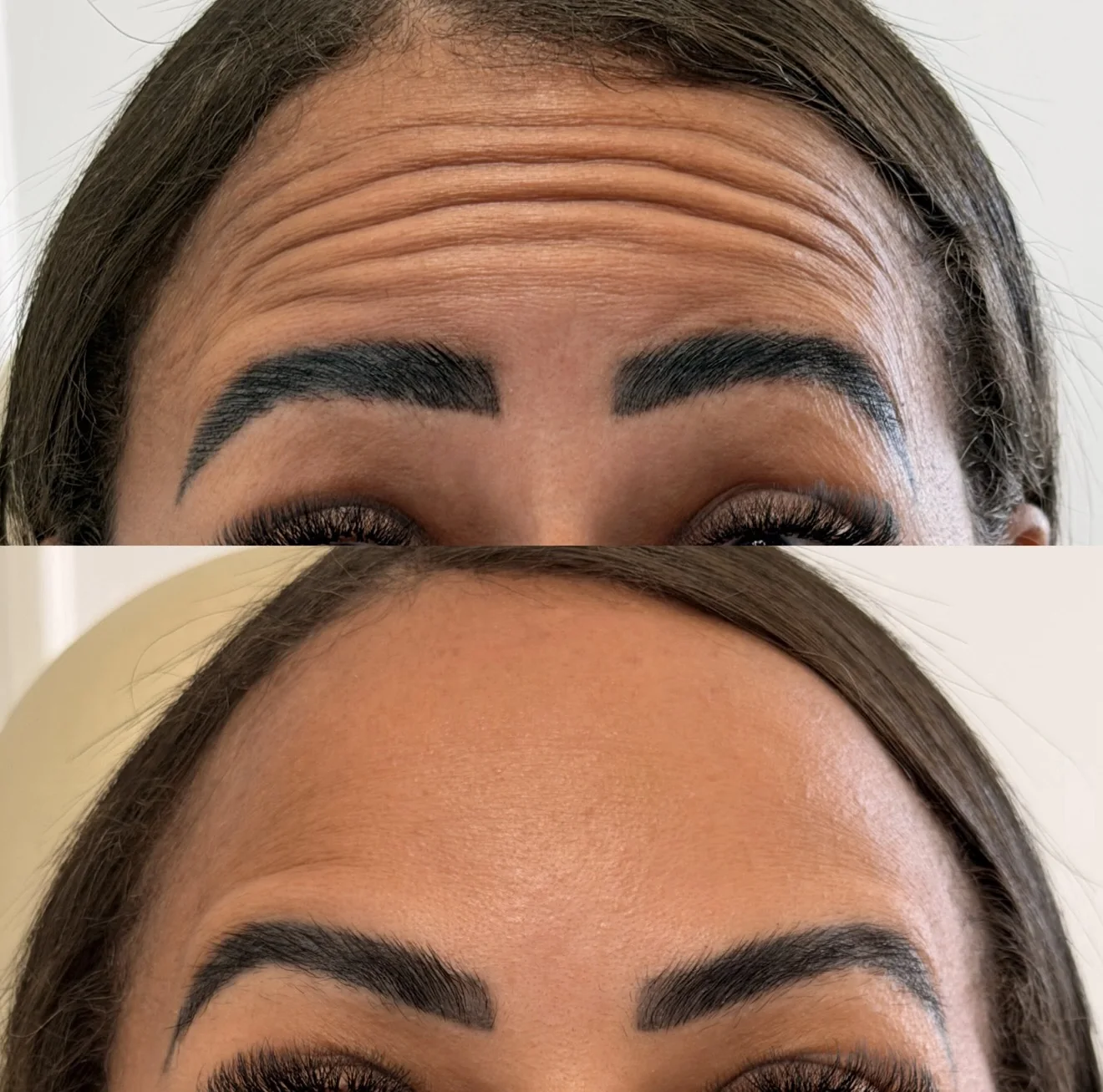 Resultado de toxina botulínica