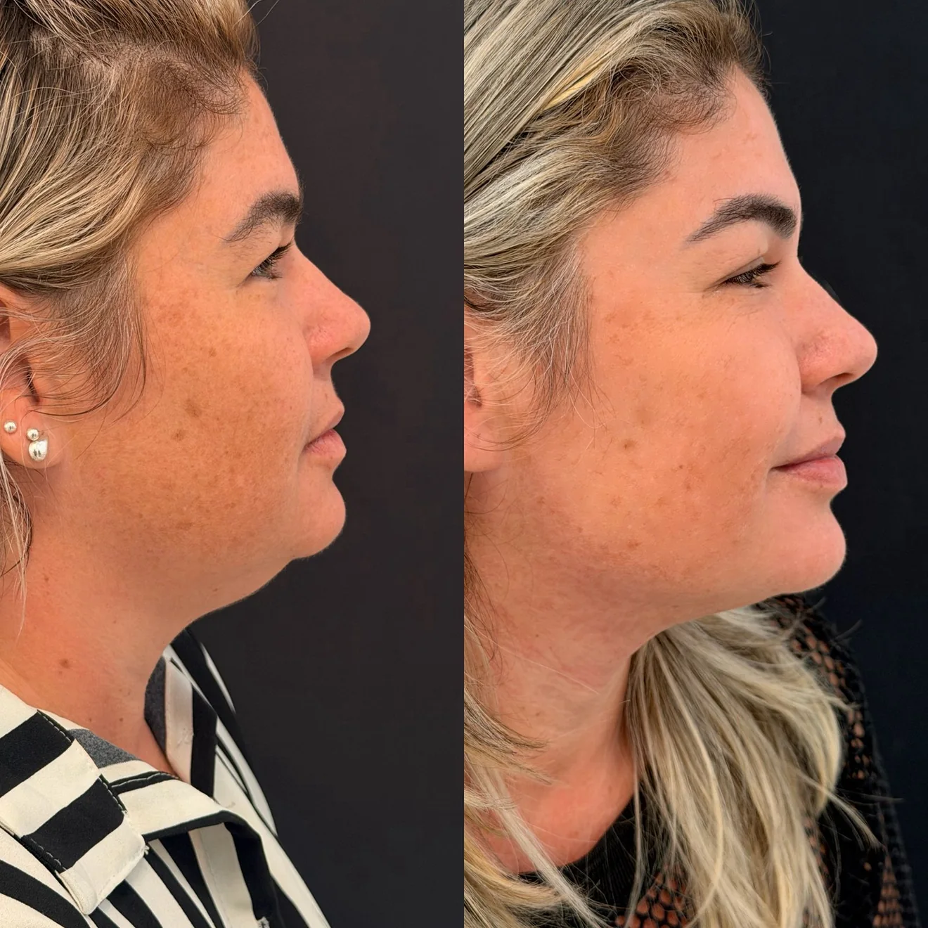 Resultado de lipo de papada