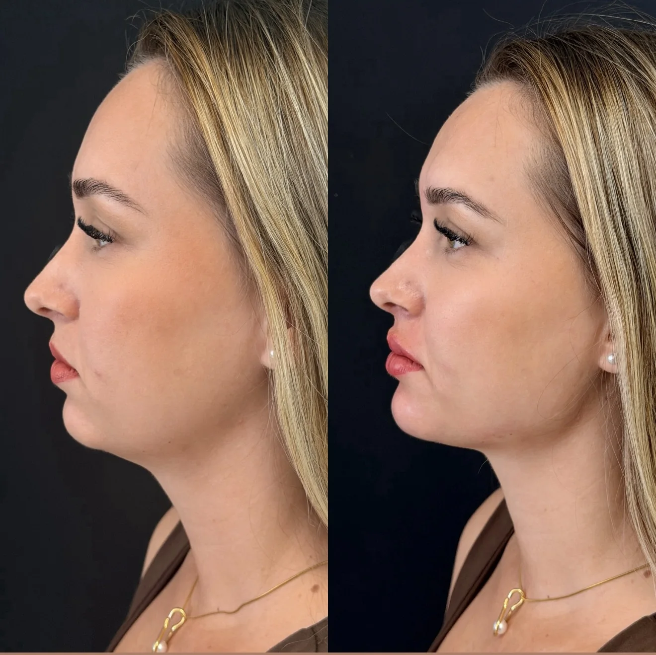 Resultado de perfiloplastia