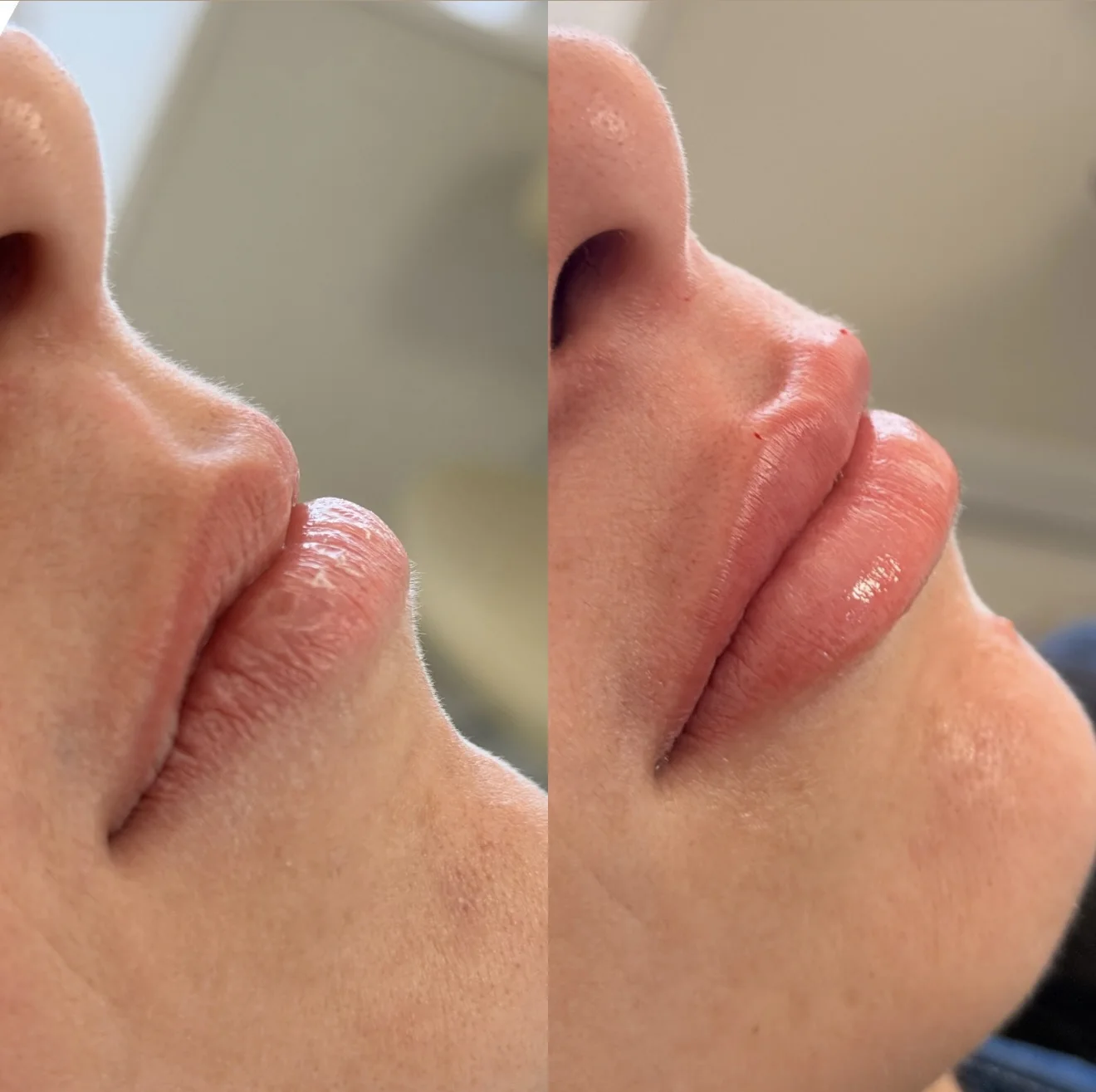 Resultado de preenchimento labial